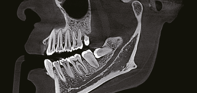 КЛКТ-срез, снятый на Eighteeth FinScan F350