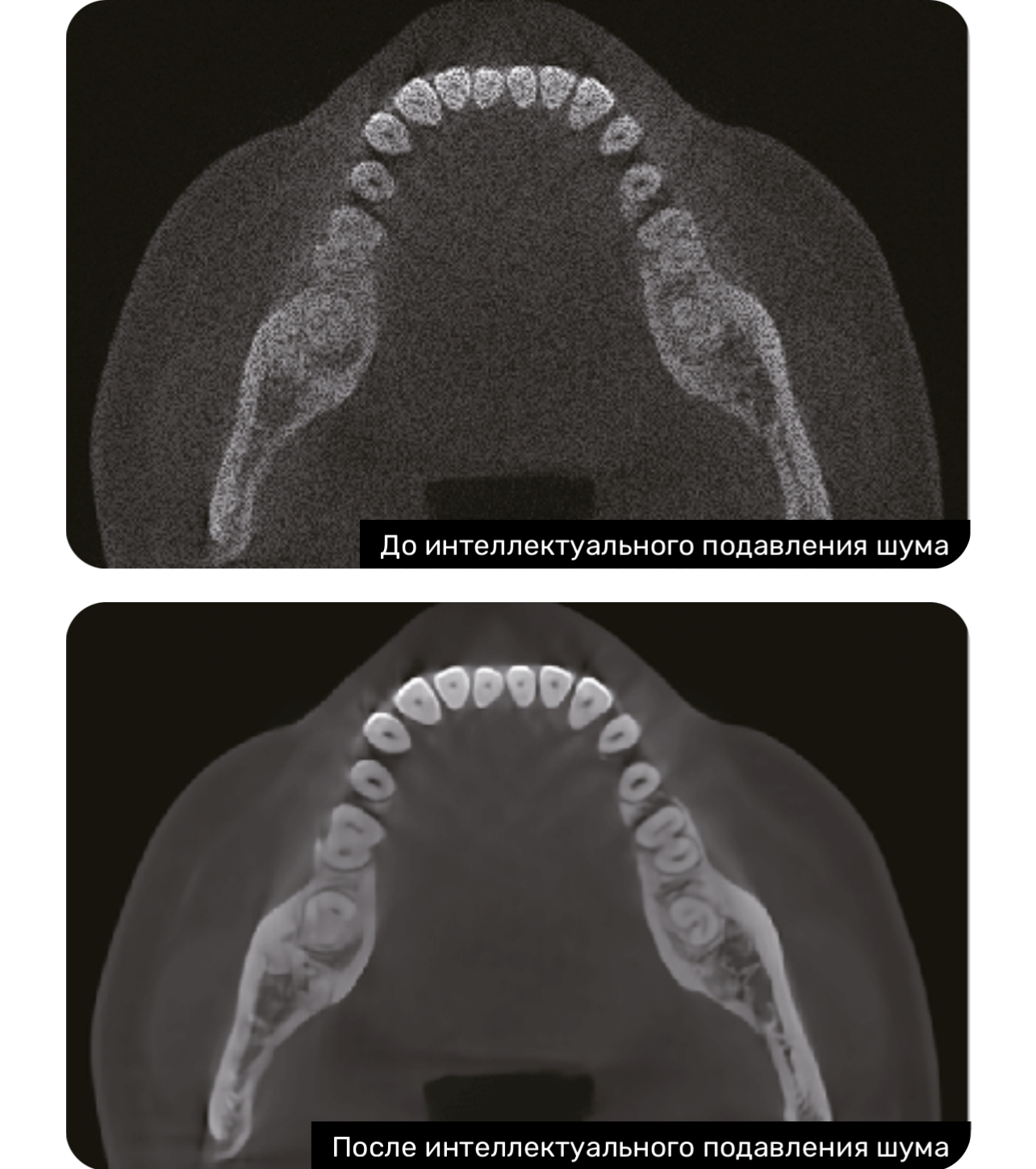 Eighteeth FinScan F350 16x10 - дентальный 3D томограф с ПК, фото 5